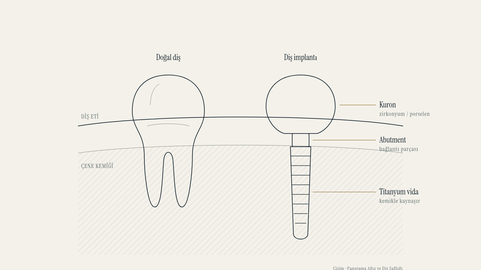 Çene kemiği kesitinde doğal diş ile diş implantının parçaları: kuron, abutment ve titanyum vida