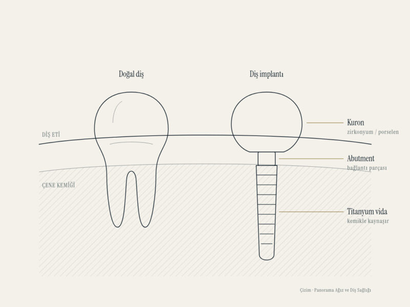 Çene kemiği kesitinde doğal diş ile diş implantının parçaları: kuron, abutment ve titanyum vida